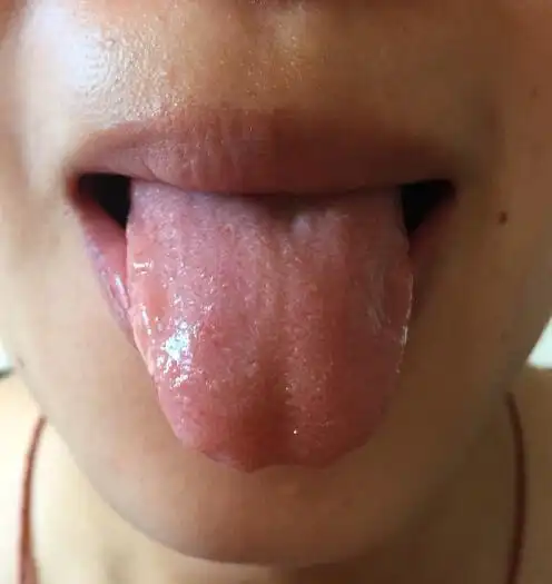 寻求健康的成年人舌苔照片