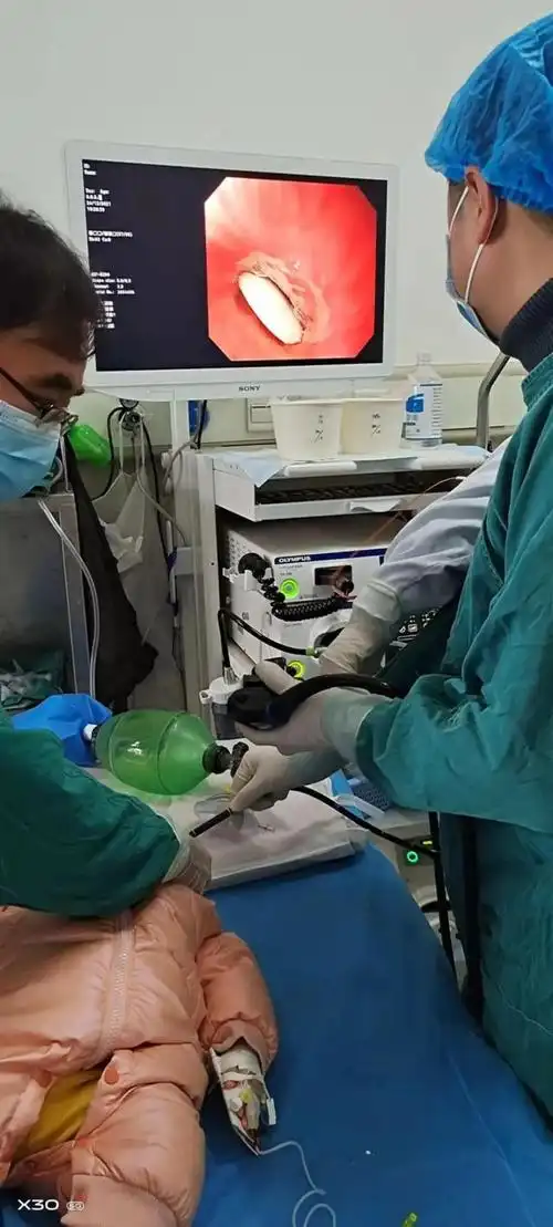 四川巴中8个月大婴儿误吞棋子医院对其全麻后通过胃镜取出