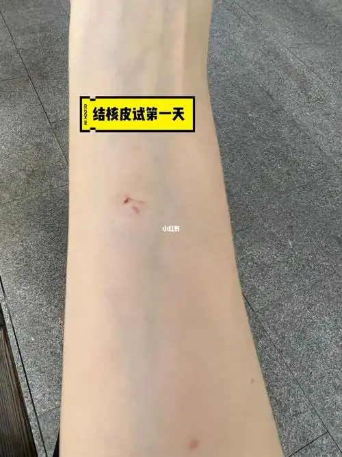 结核筛查  #ct  #健康体检  #肺结核皮试  #结核  #首都医科大学附属