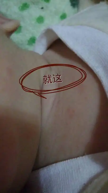 推荐回答 病情分析:   你好,考虑是皮脂腺囊肿引起的   指导意见