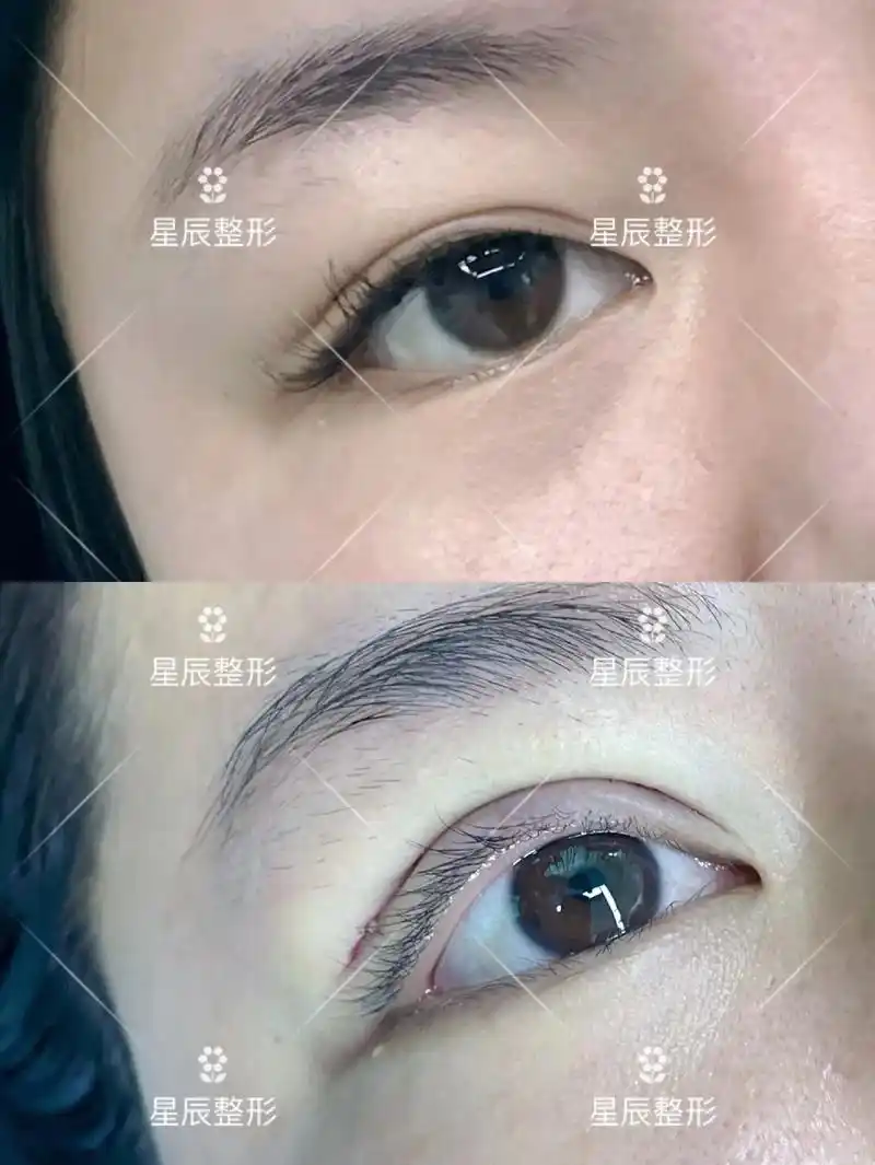 97毕业季·眼鼻整形黄金期    73芭比眼综合案例分享 99 - 抖音