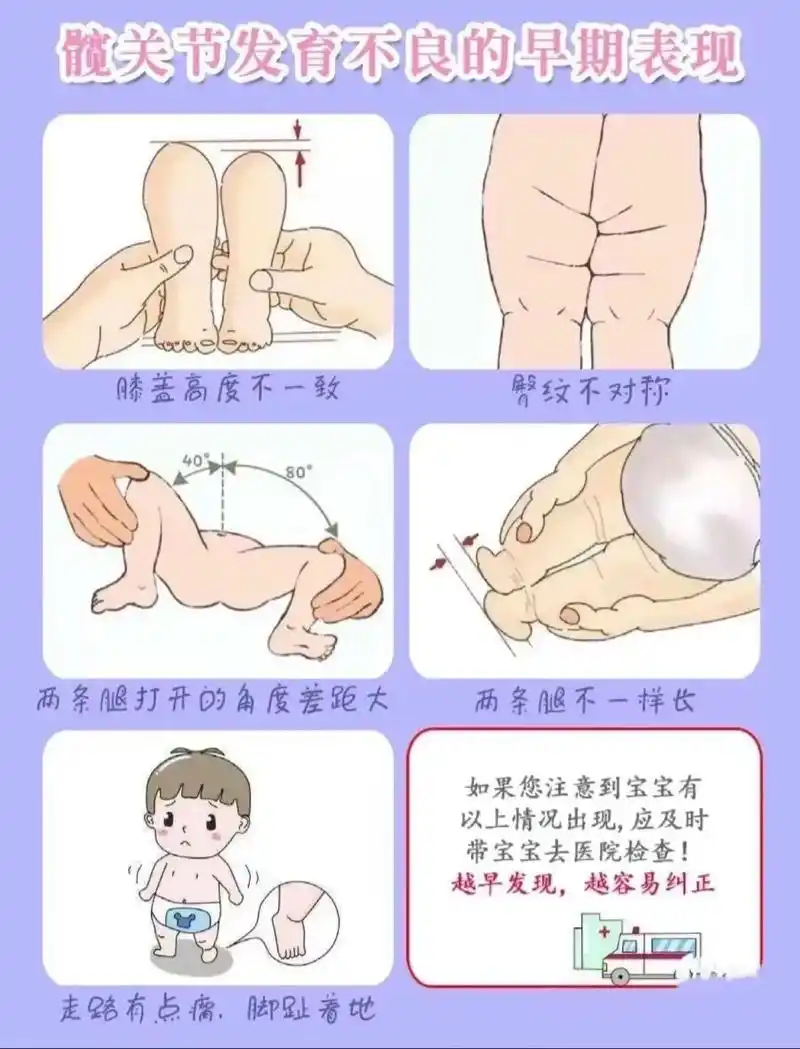 宝宝腿纹不对称