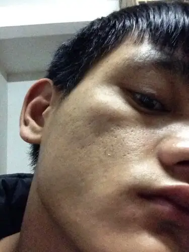 这脸的凹洞怎么去掉