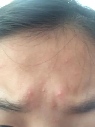 请问我这是白头粉刺吗好长时间了用芦荟胶也不管用我怕最后留在脸上