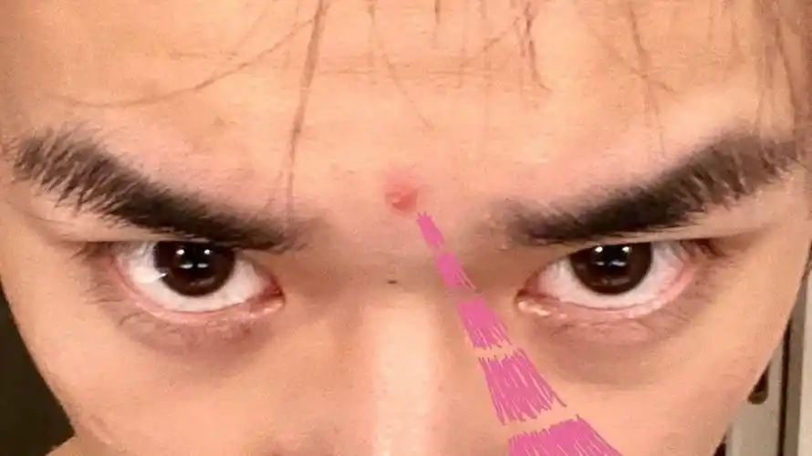 易烊千玺爆痘,在线撒娇!