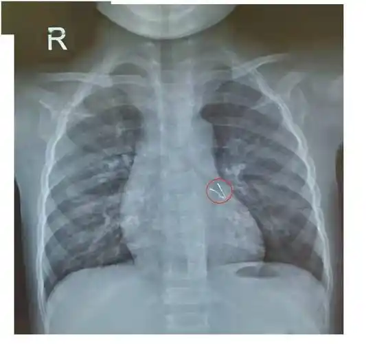 1岁半宝宝咳嗽一周肺里有"长脚"异物,竟是过节用的小灯泡_孩子_支气管
