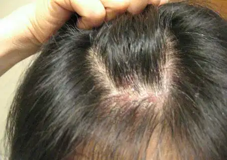 头皮银屑病图片-头部有银屑病怎么治疗-名医汇
