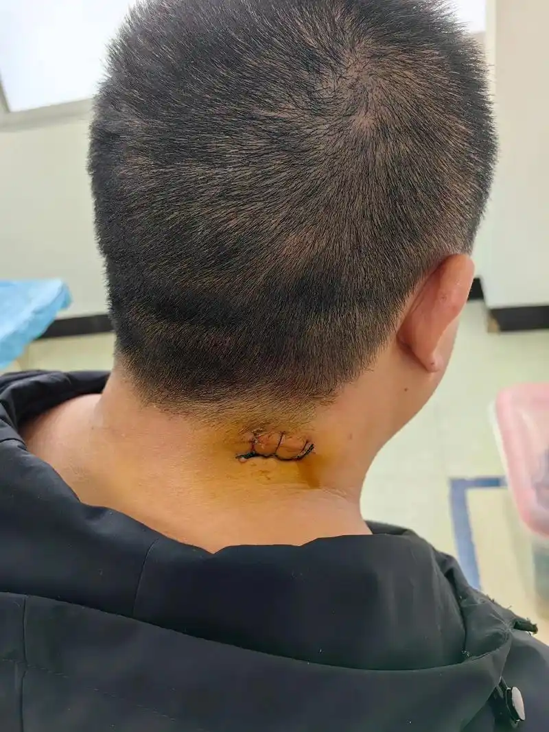 突然之间给我长个脂肪瘤!