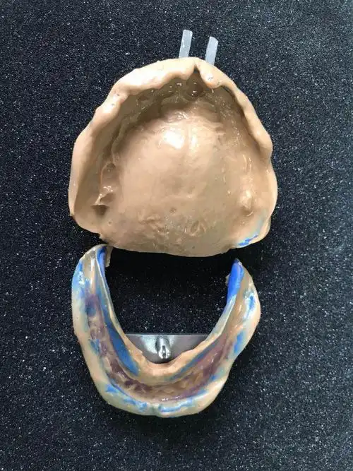 2019年1月11日常熟中医院吸附性义齿