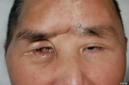【求助】男,40岁,头部挤压伤3年,眼眶爆裂性骨折,眼球内陷,暴露性角膜