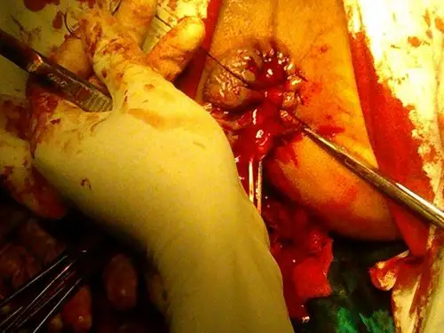 血栓性外痔图片53