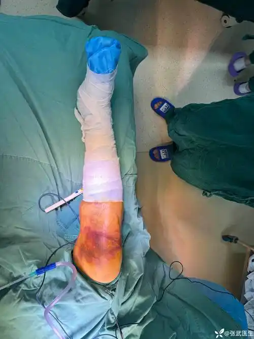 讨论髌骨骨折克氏针张力带钢丝的绑法