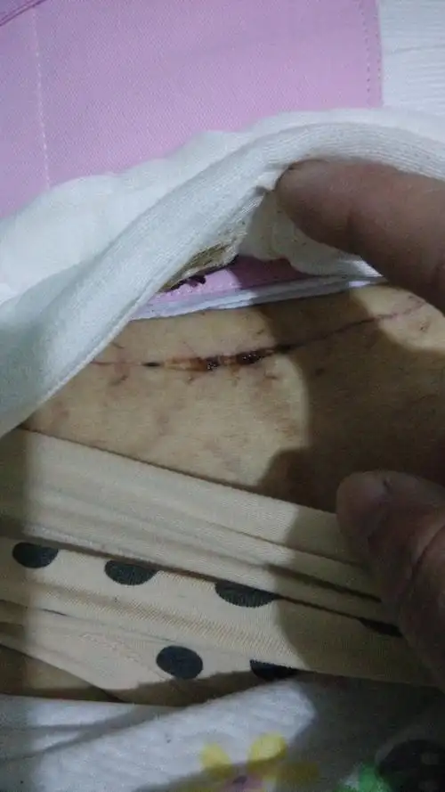 老婆剖腹产8天了伤口感觉有点开裂这严重吗该怎么办