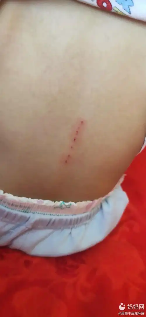 第一次不小心把宝宝背刮伤了,好自责