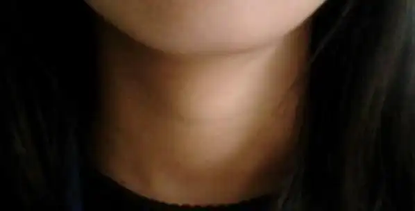 十八岁女生,这个算喉结吗,第一张是把头抬起来的样子,第二张是稍微抬