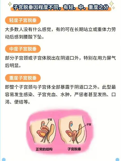 子宫脱垂的危害你了解有多少72