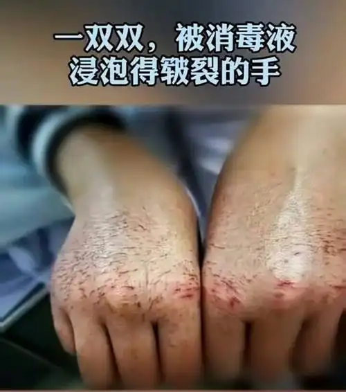 一双双被消毒液  浸泡得皲裂的手