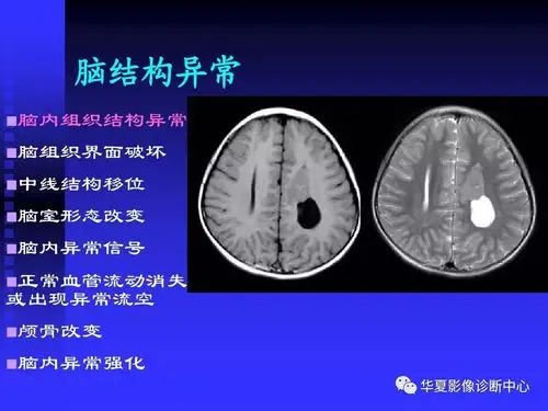 基础必备头颅mri读片知识