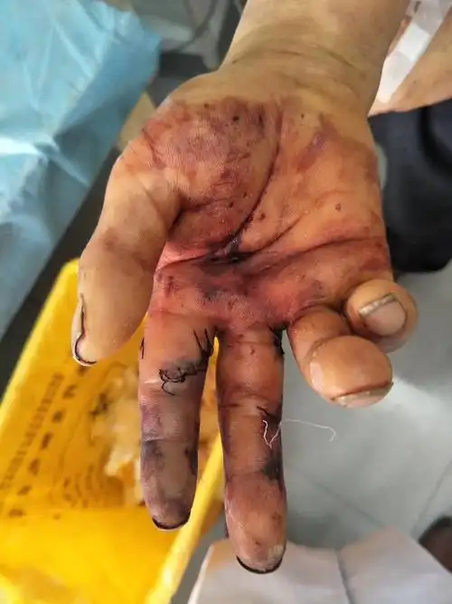 47岁,虞某某,右示中指水泥砖砸伤致疼痛流血畸形离断在当地卫生院清创