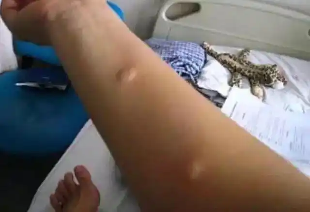 青霉素皮试六大知识点