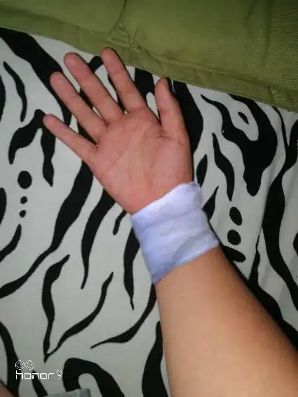 今天有新闻报道,3岁女孩左手无名指受伤后,因社区医院包扎的纱布脱落