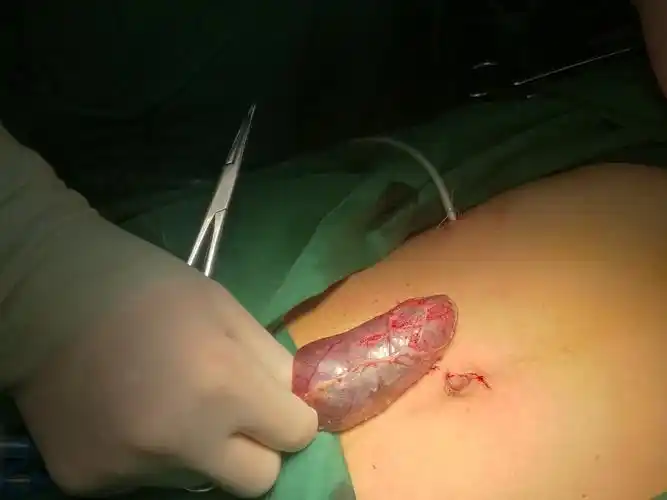 减孔腹腔镜胆囊切除术 - 好大夫在线