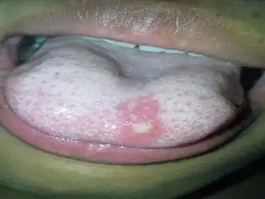 溃疡性口炎舌头尖溃疡发白图