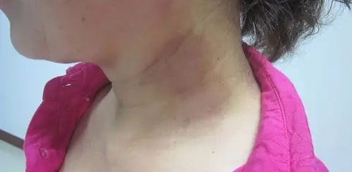 治疗3个月,白斑消失,愈后巩固中【专家点评】白癜风患者在治疗白癜风