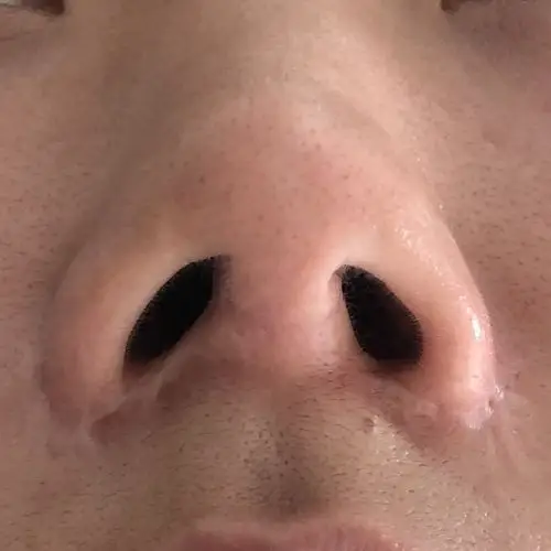 混合型鼻翼疤痕修复