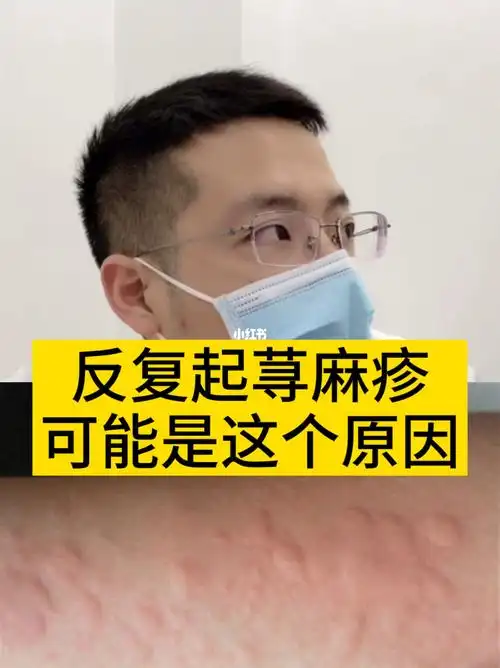 反复起荨麻疹可能是这个原因