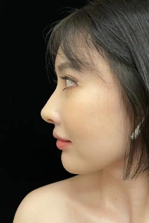 肋骨鼻##江宝华鼻整形##鼻修复