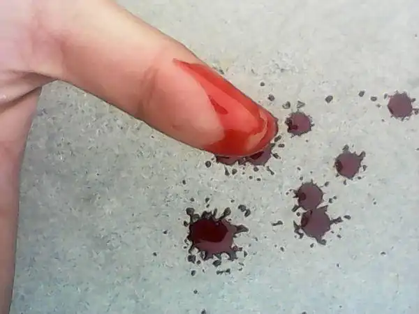 好疼,流了好多血,现在指头麻木了,没事吧