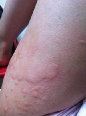 东城风疹医院_东城治疗风疹哪家医院好_东城治疗风疹最好的医院/排行