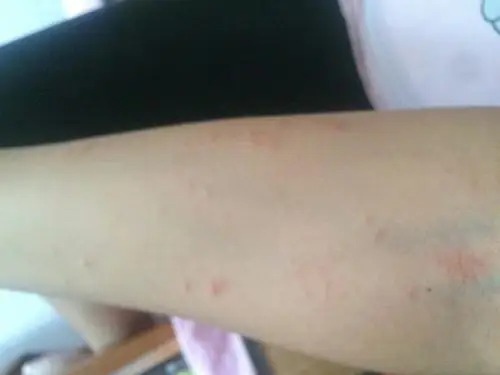 急解 急解 万能的宝妈群,快告诉我碰芒果过敏了怎么治?