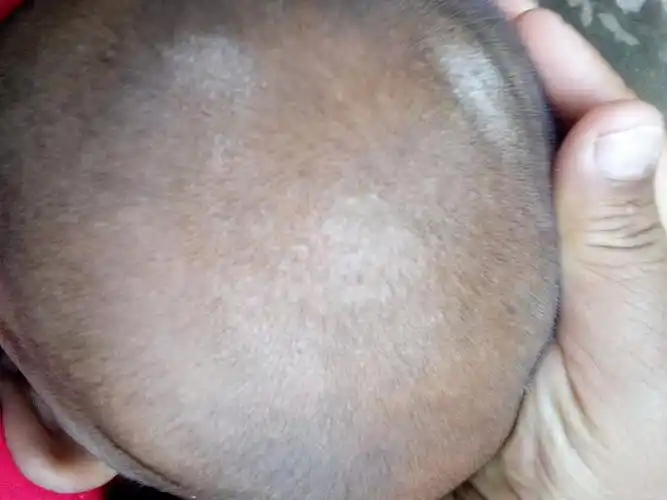 我儿子的头上会有这样的白斑,请问一问要涂的啥