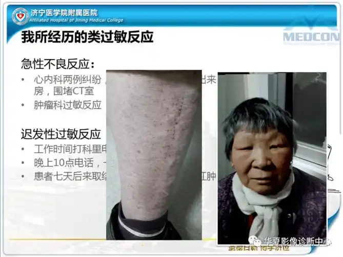 减少造影剂过敏,饮水很重要