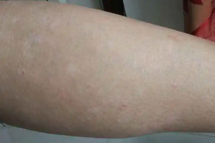 增大至指甲盖大小,呈圆形或类圆形,邻近皮损可相互融合呈不规则大片状