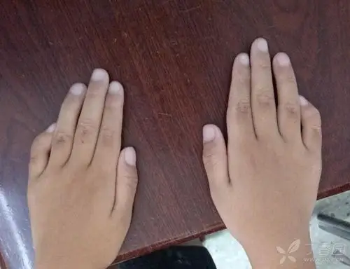双侧指骨畸形 我报"倾斜指"你看中不中 [病例帖]