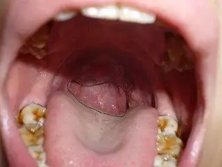 喉咙生痢泡是什么原因引起的