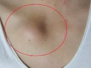 这是锁骨突出吗?