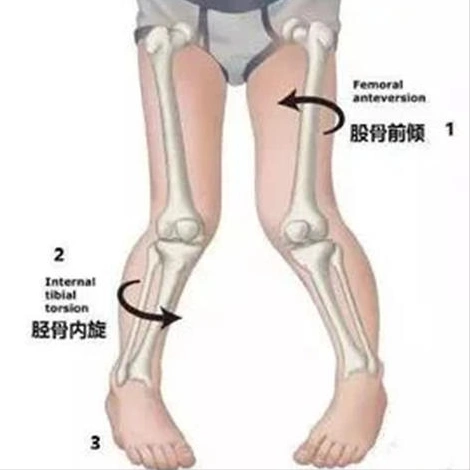 的腿骨发育带来巨大的伤害,也是这个孩子走路为什么内八的重要原因