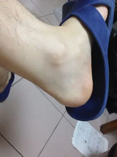 跟腱特别疼一按就疼而且是那种里面疼.之前就有过.但没有在意.