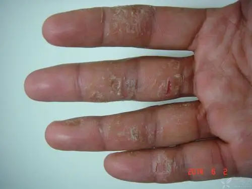 【求助】请求诊断与治疗:手指皮肤反复局部角质,皲裂,脱皮近一年.