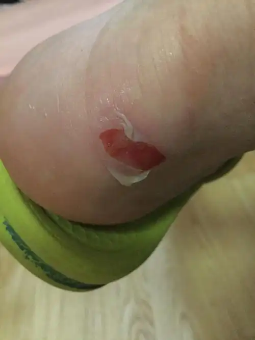 磨啊磨我觉疼但也没在意就继续走一到学校发现已经磨破皮了很大一块里