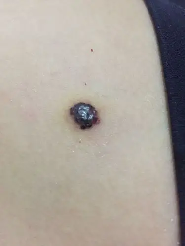 腿上有一个黑疙瘩,这是什么?