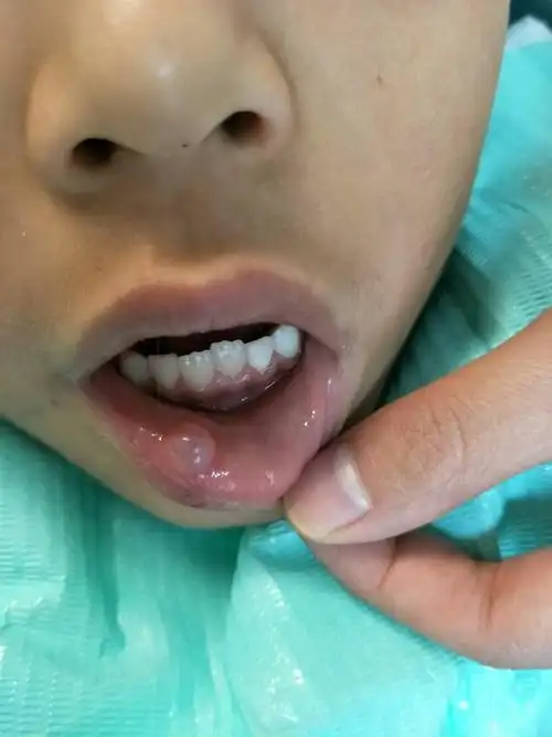 无痛微创下唇粘液腺囊肿术