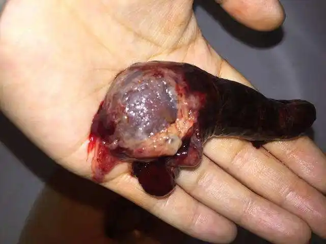 什么也不是,只是些12周胎停育自然流产成功怀孕初期 恶心 下腹疼 怎么