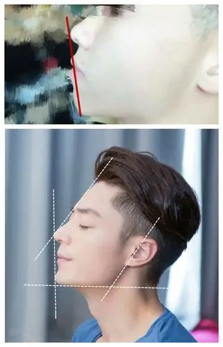 下巴短且后缩,请问我比较适合打玻尿酸还是装假体?