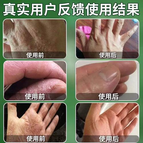 掌脱皮膏风疗鹅手治真菌感染季节性严重脱皮乾裂手痒乾燥专用膏
