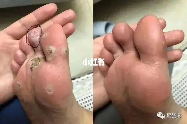 瑶张记跖疣怎么才能自愈